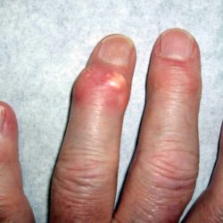 Gout tophaceous wrist swelling patient information wikidoc index