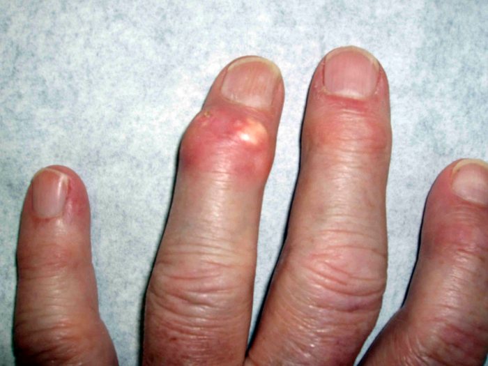 Gout tophaceous wrist swelling patient information wikidoc index